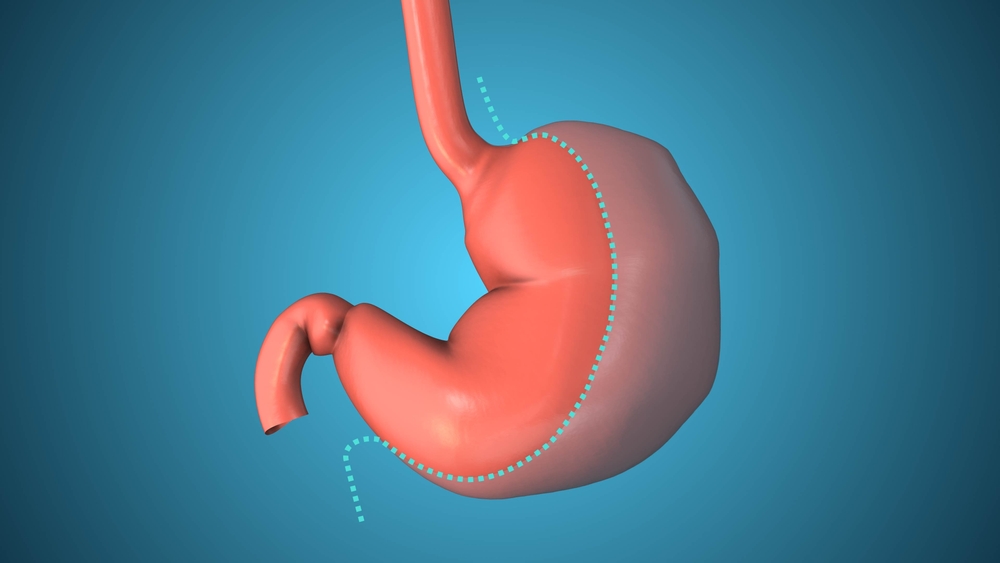 sleeve gastrectomy in dubai at novomed clinic