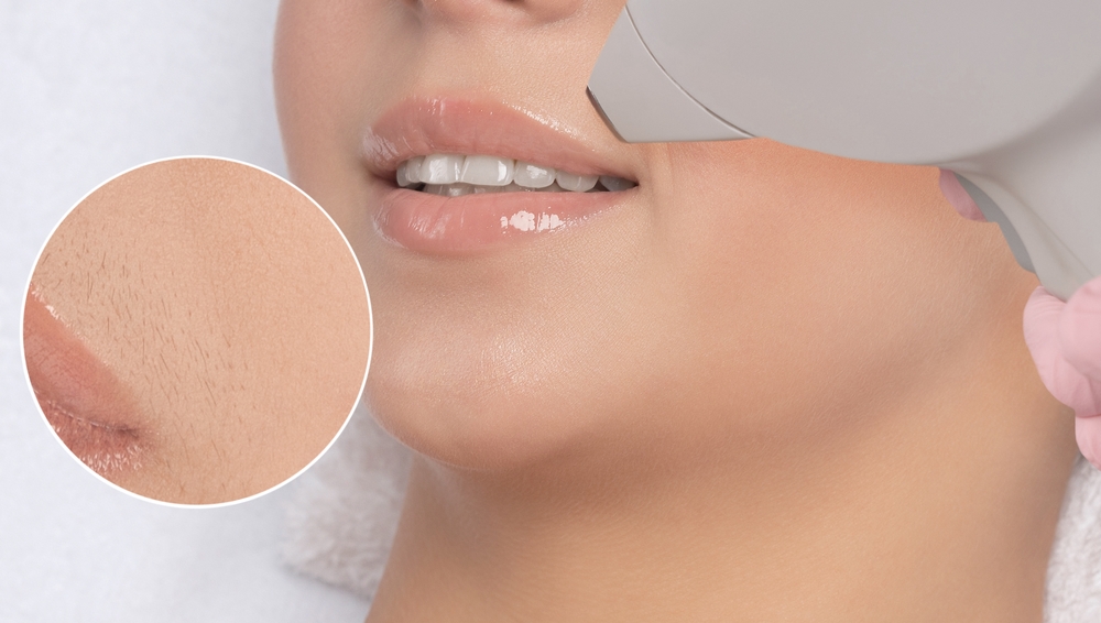 upper lip laser hair removal in Dubai at novomed