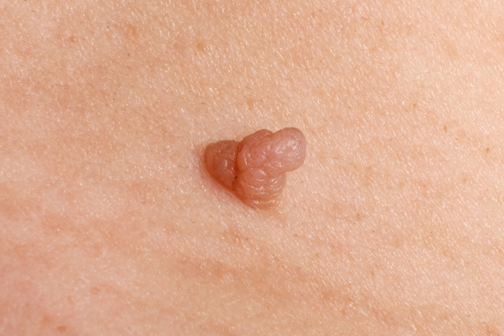 skin tag removal dubai at novomed clinic