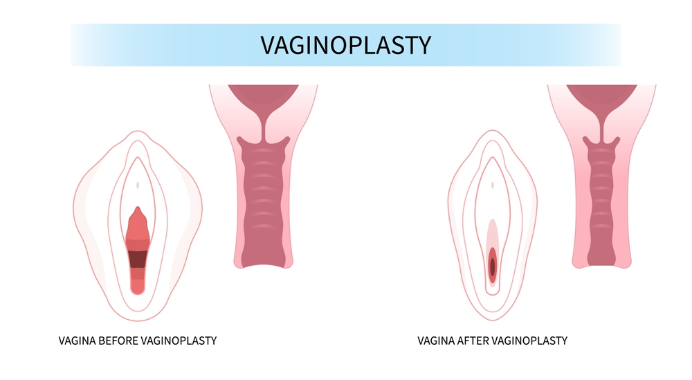vaginal tightening in dubai at novomed clinic