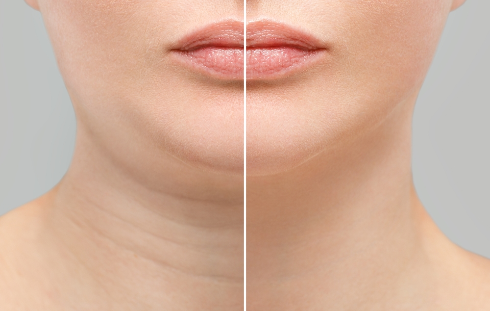 chin liposuction in dubai at novomed clinic