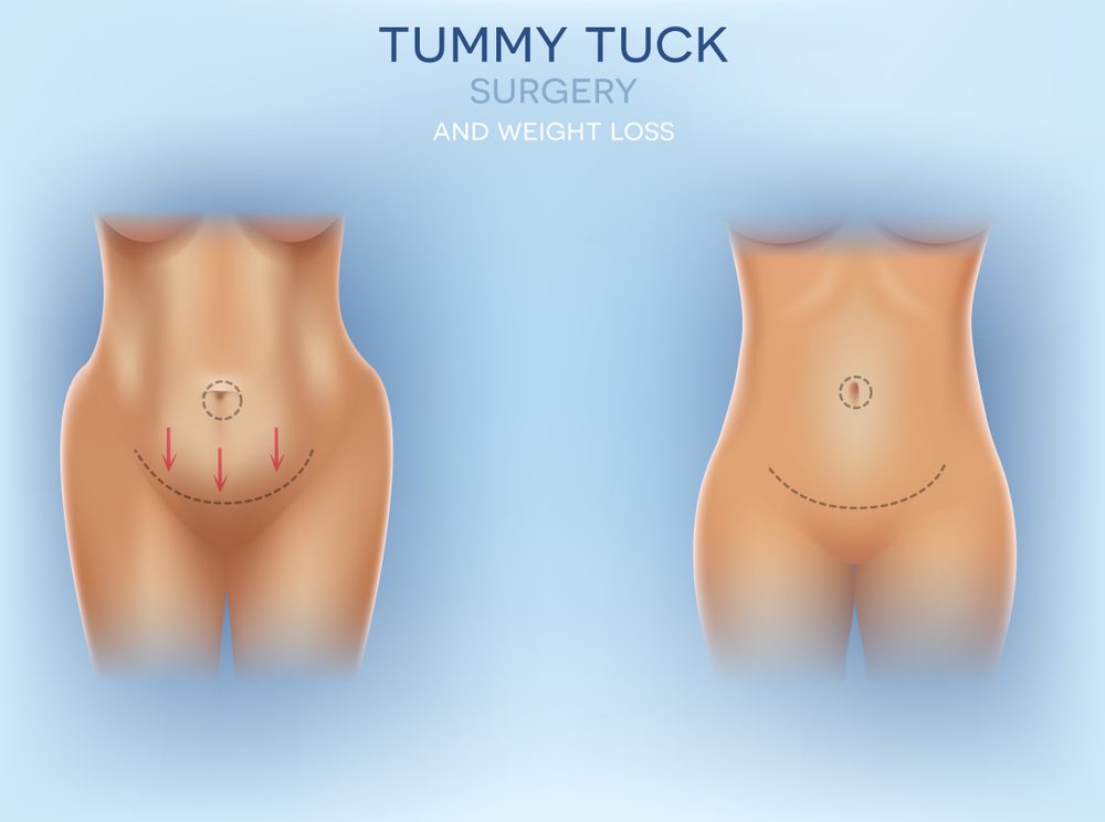 mommy makeover surgery in dubai at novomed clinic