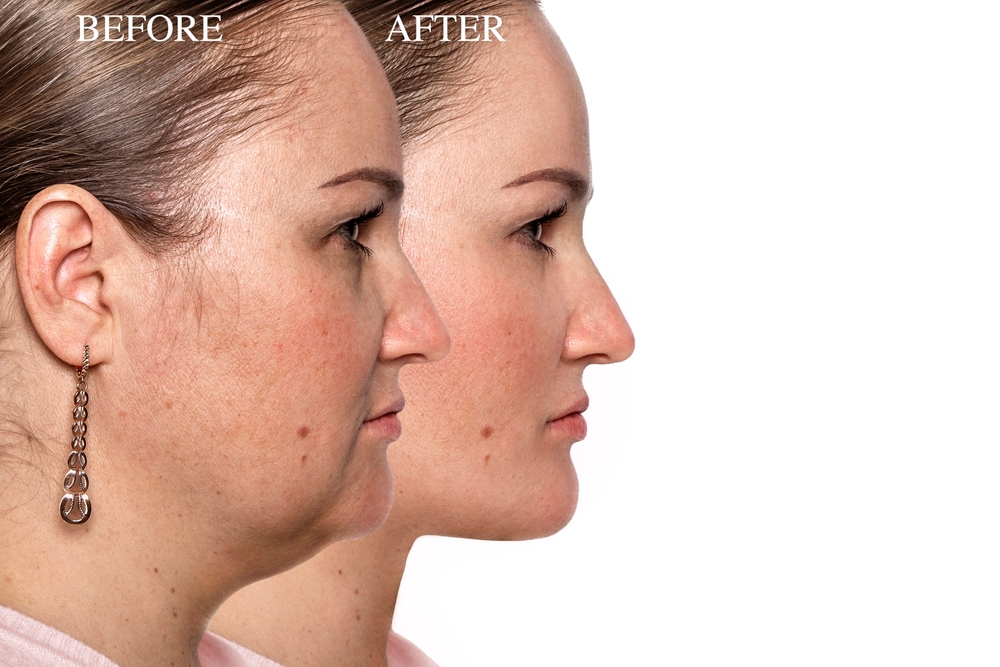 double chin removal dubai at novomed clinic