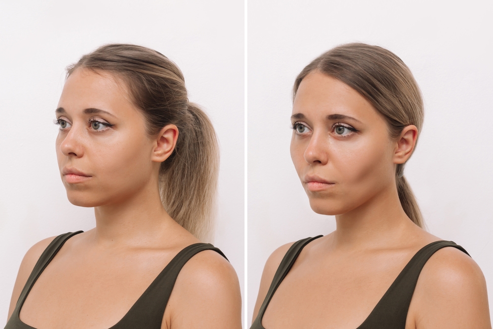 buccal fat removal in dubai at novomed clinic