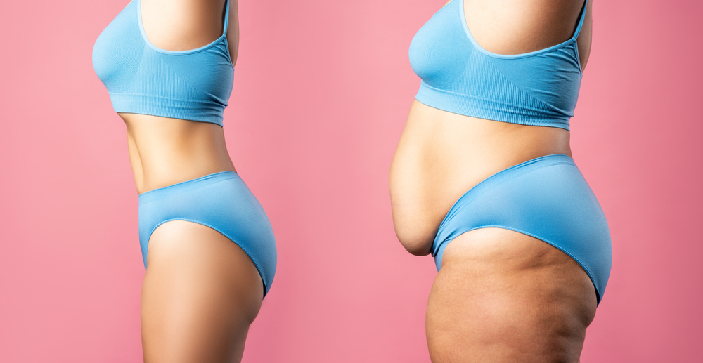 best liposuction in dubai at novomed clinic