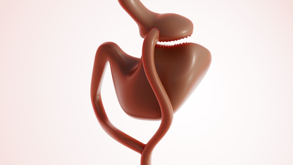 Gastric Bypass Surgery in Dubai | Novomed