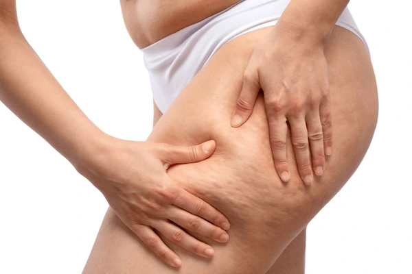 lady during cellulite treatment session at novomed clinic in Dubai