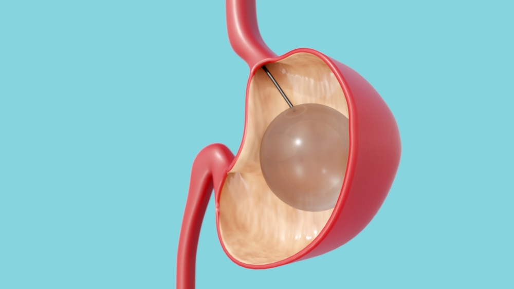 Gastric Balloon dubai at novomed clinic