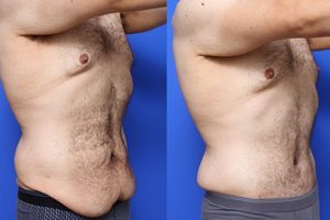 tummy tuck