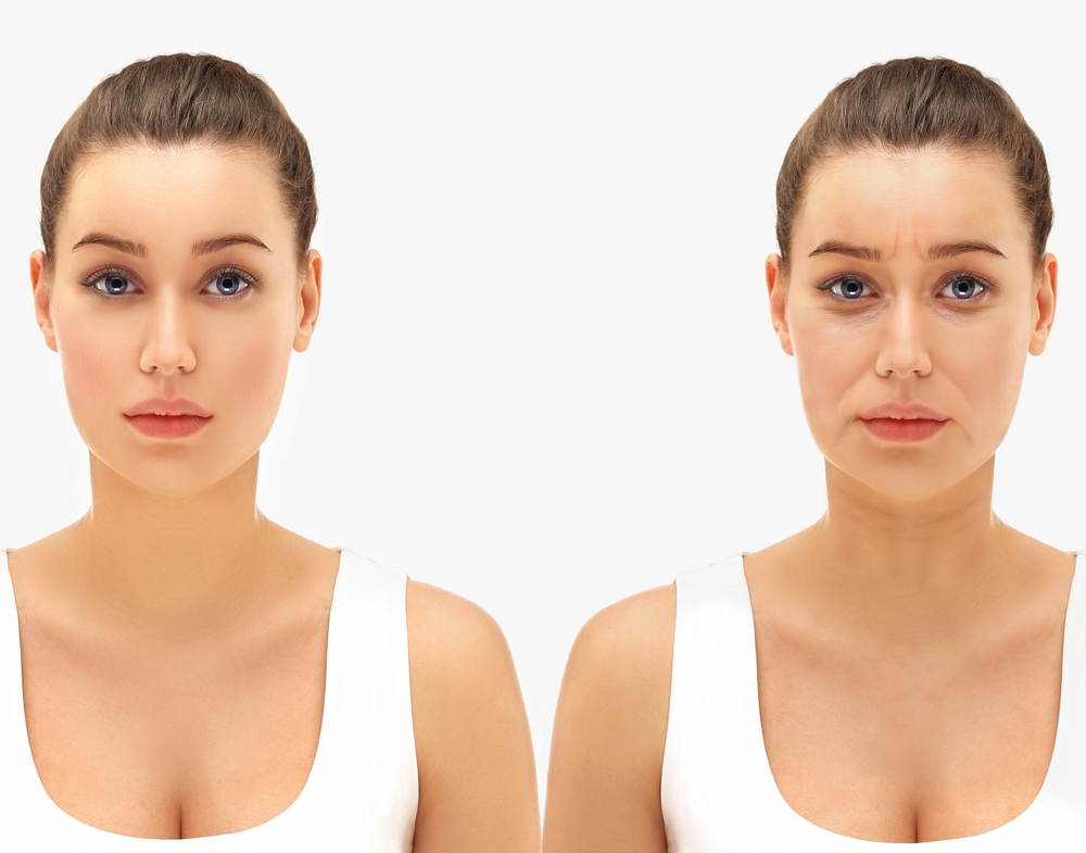Marionette Lines treatment at novomed clinic