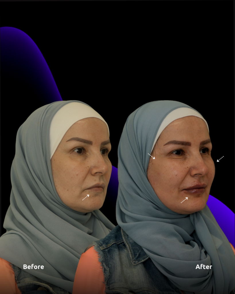 results of face and lip dermal fillers at novomed Dubai