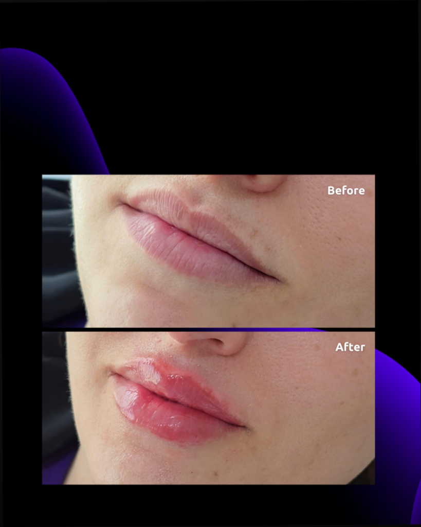 results before and after for lip fillers at novomed in Dubai