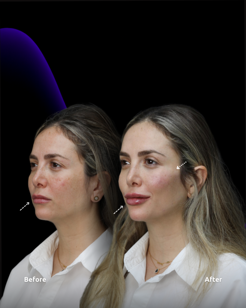 results before and after face and lip Dermal filler at novomed clinic in Dubai