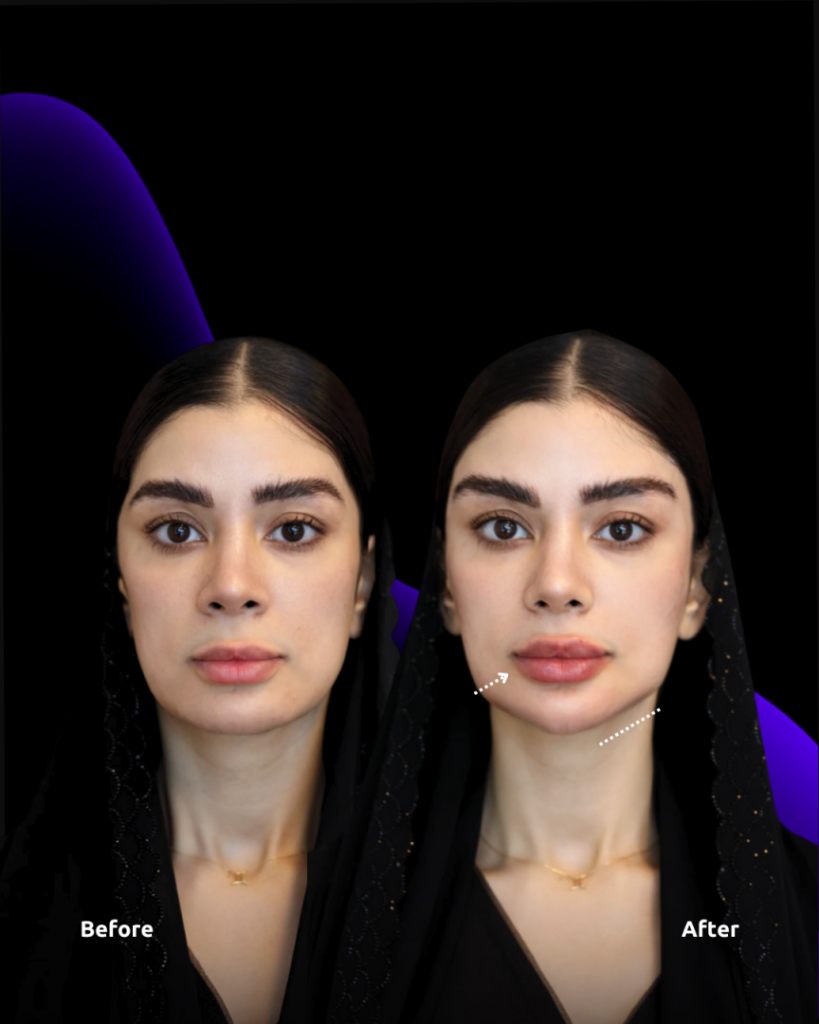 before and after lip filler in dubai at novomed
