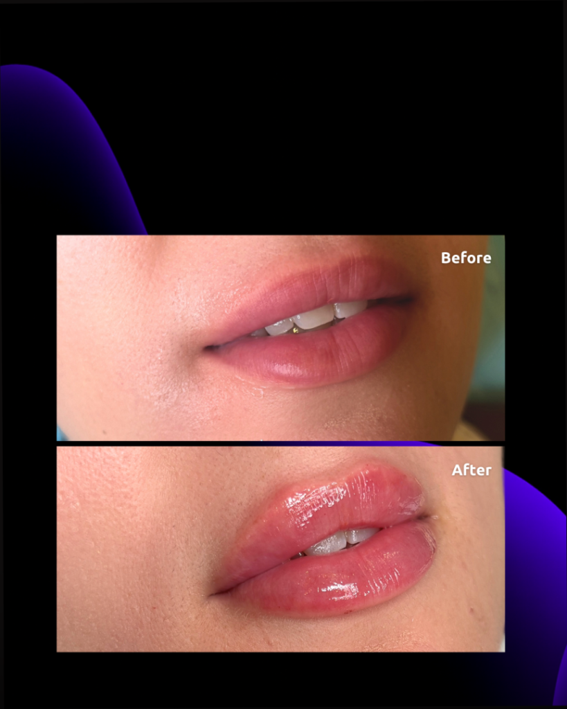 lip filler injection results after treatment at novomed