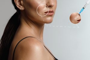 Nasolabial Folds filler at novomed clinics in Riyadh, KSA 