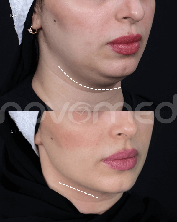 double removal at novomed before and after results