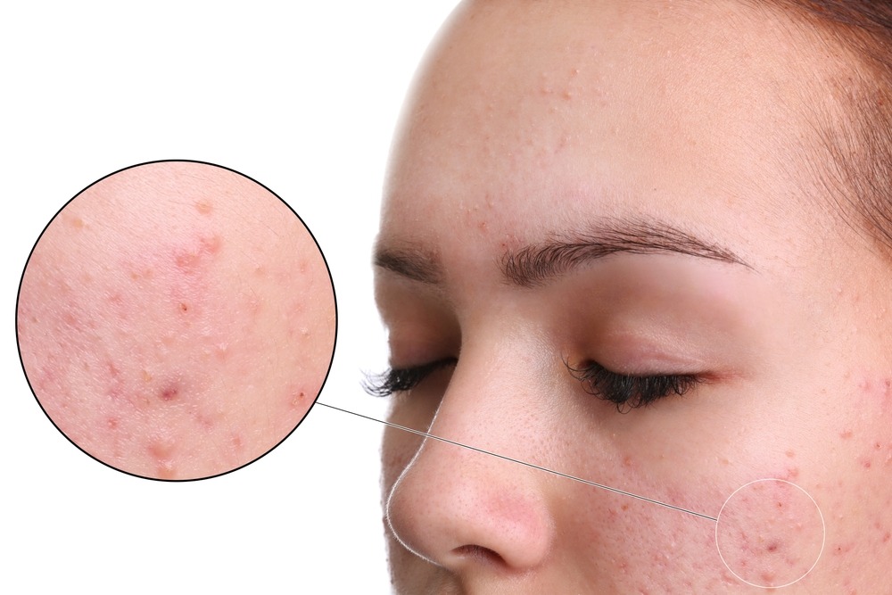 Acne treatment at Novomed Clinic, Riyadh