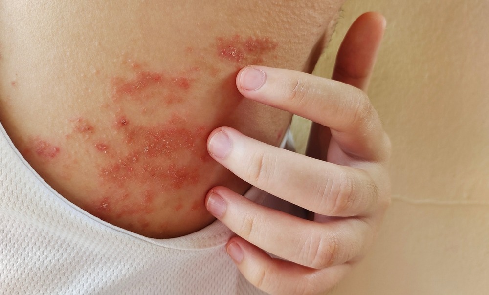 علاج الاكزيما في الرياض نوفومد