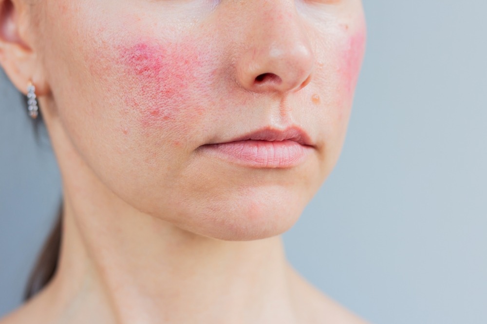 Rosacea treatment at novomed clinic in riyadh