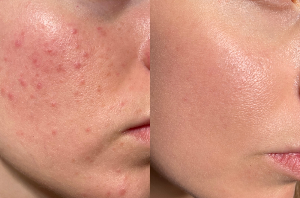 acne treatment in riyadh at novomed clinic