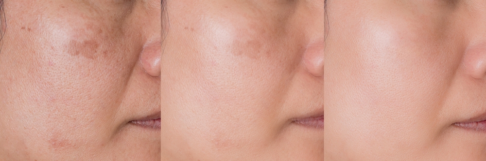 Pigmentation Treatment before and after novomed clinic