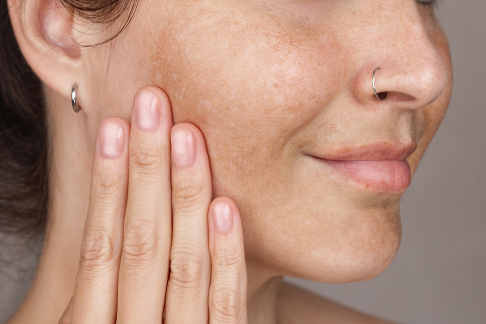Melasma Treatment in riyadh at novomed clinic