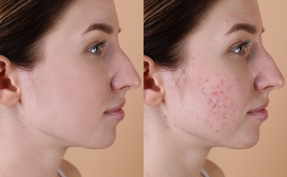 acne treatment riyadh at novomed clinic