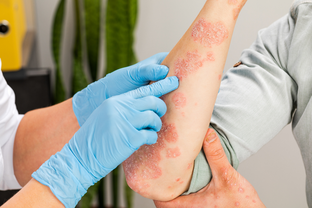 Psoriasis treatment at novomed clinic in riyadh