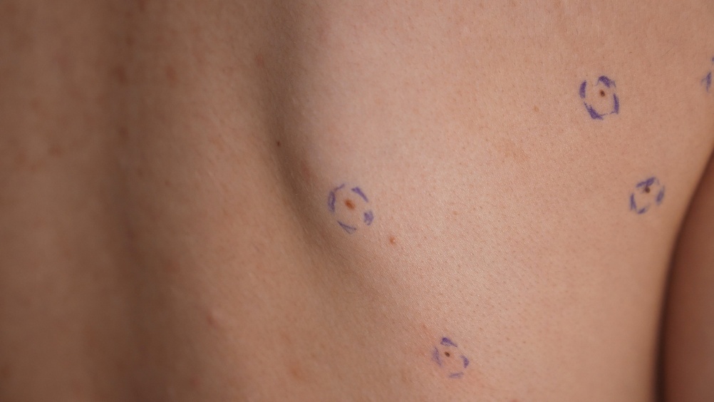 mole mapping in riyadh at novomed clinic