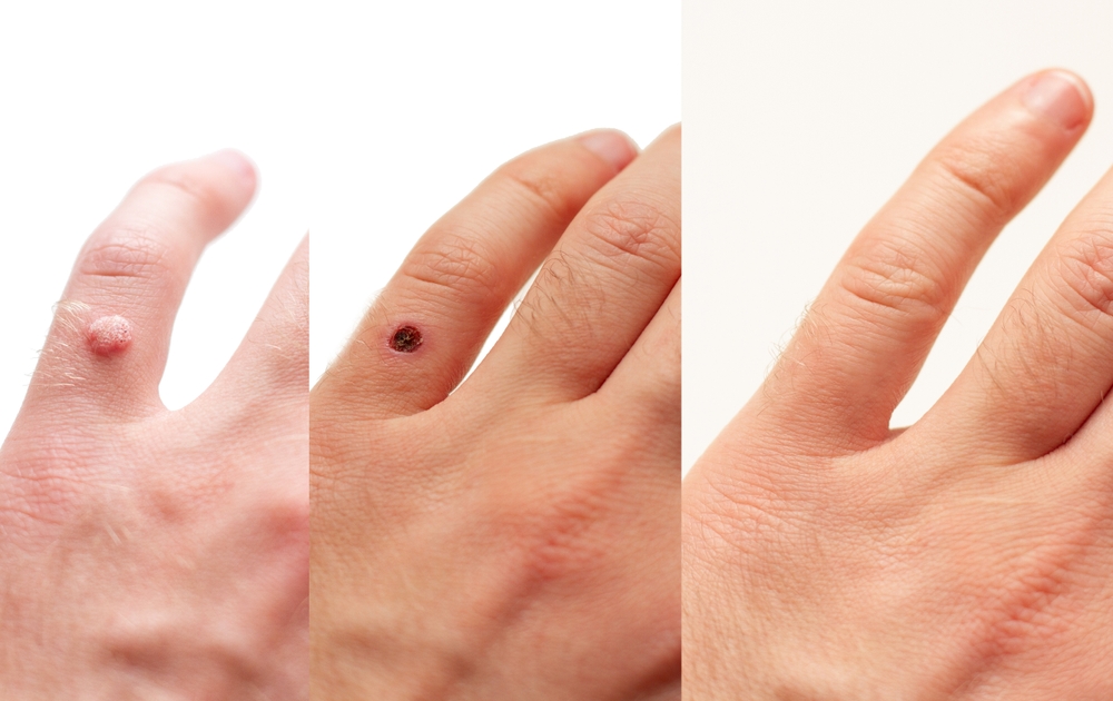 laser wart removal riyadh at novomed
