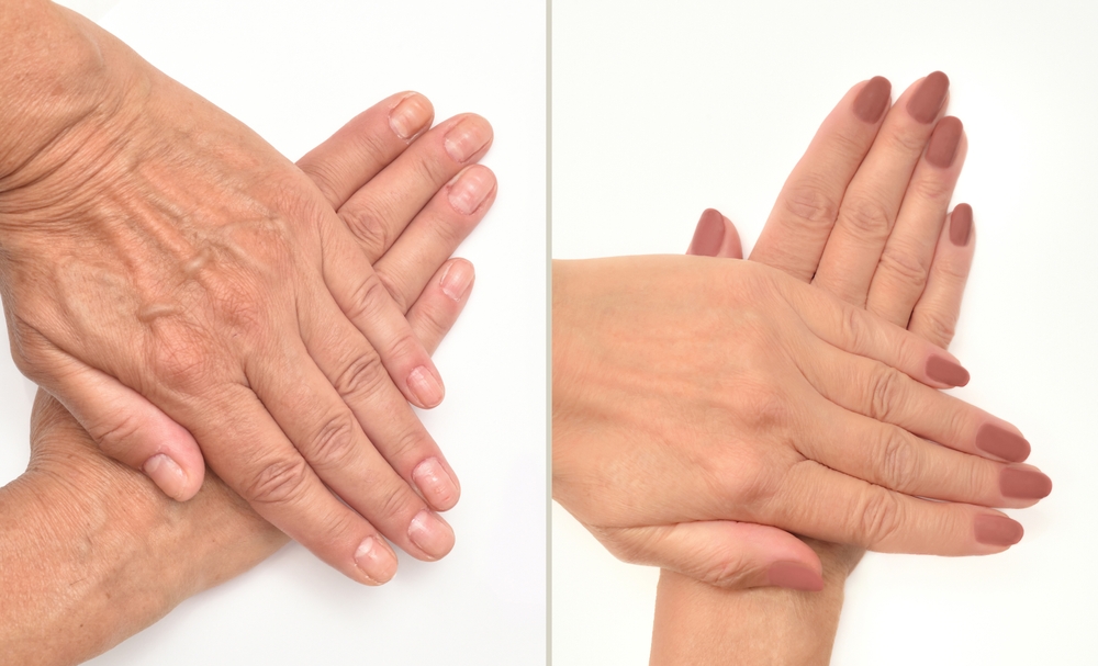 hand Rejuvenation in riyadh at novomed clinic