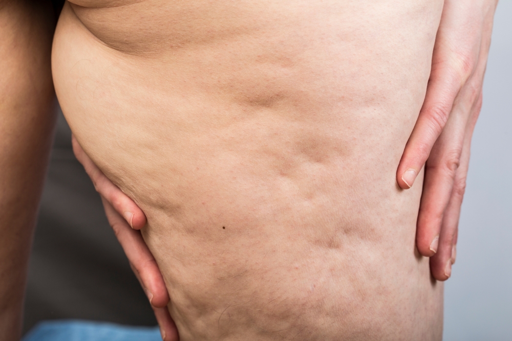 Cellulite removal riyadh at novomed clinic