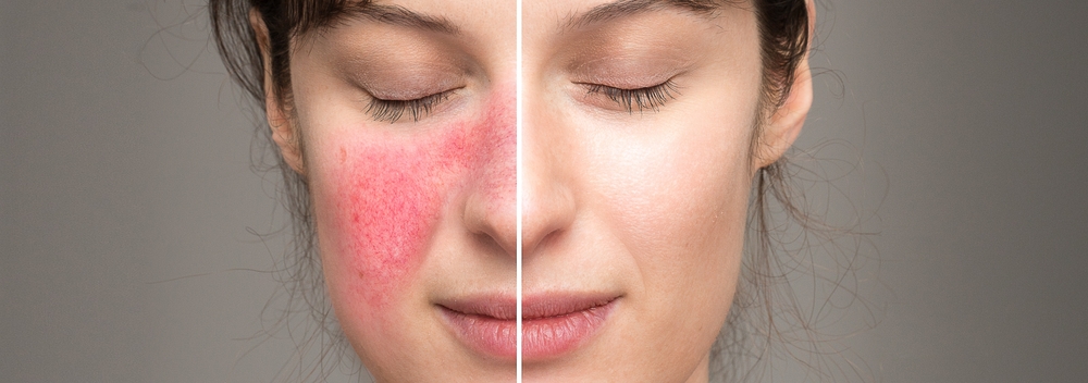 rosacea redness treatment riyadh novomed