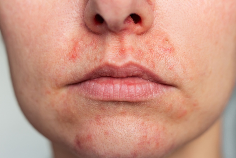 atopic dermatitis treatment in riyadh at novomed clinic