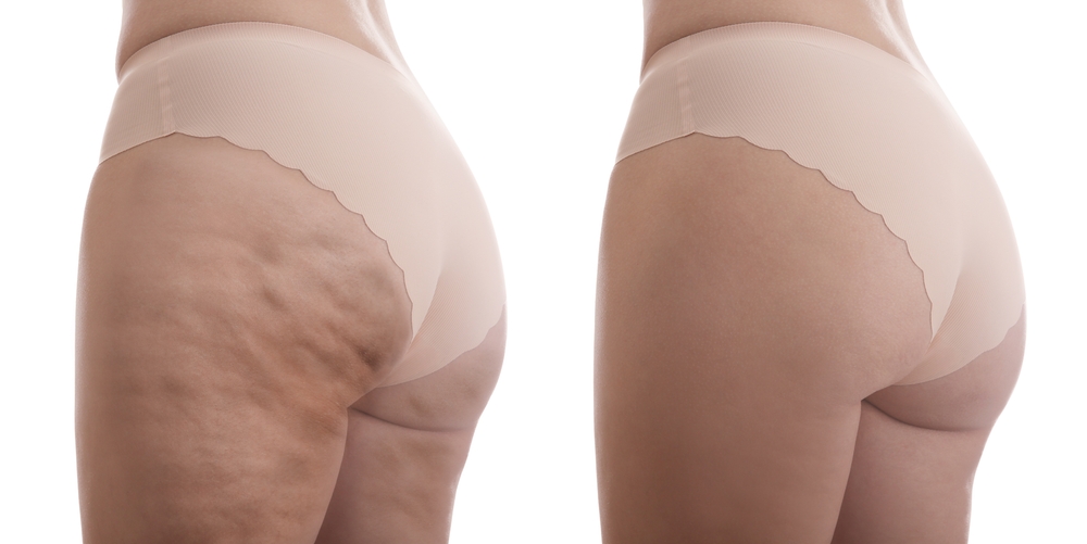 cellulite reduction novomed riyadh clinic  