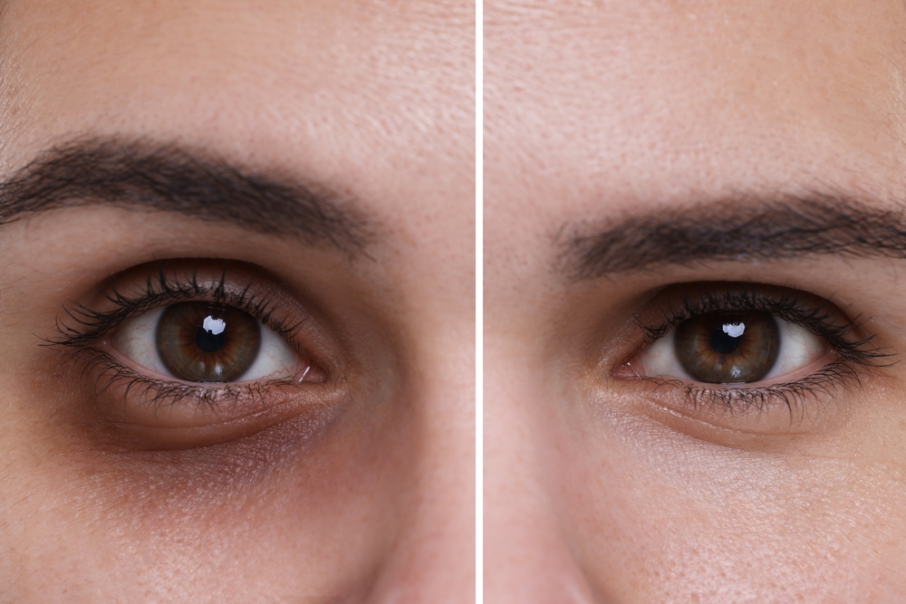 Dark Circles & Under-Eye Bags treatment at novomed clinics