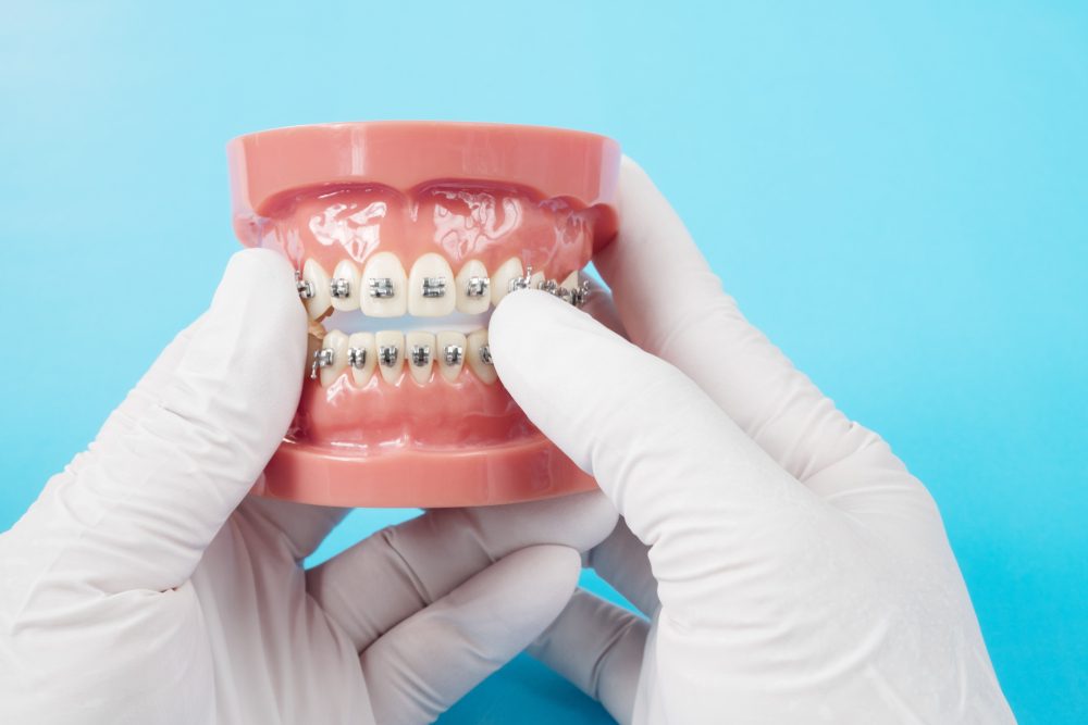 Braces at novomed dental clinic in Dubai