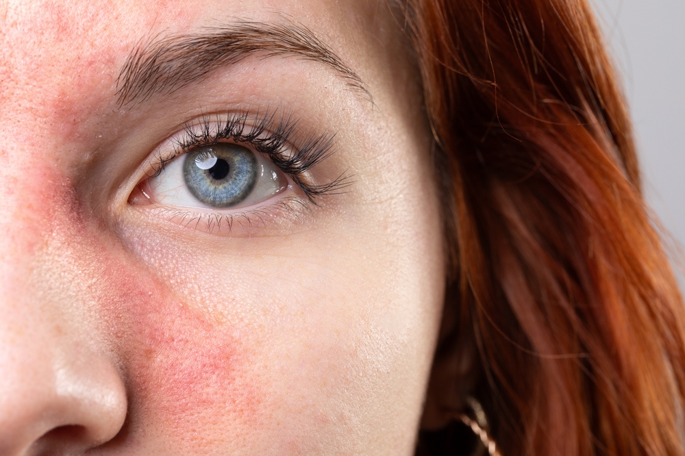 Rosacea Treatment in Riyadh AT NOVOMED