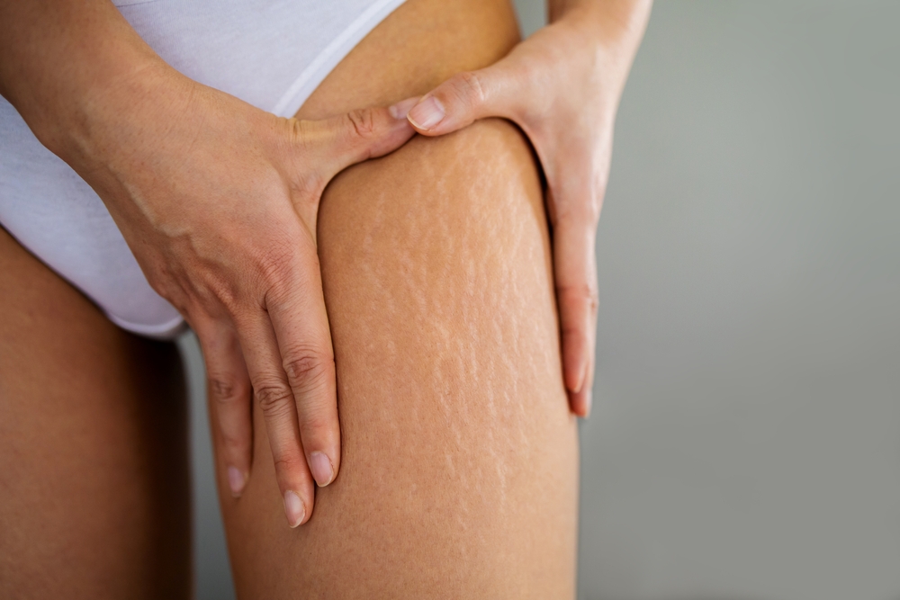 Stretch Marks treatment novomed clinic