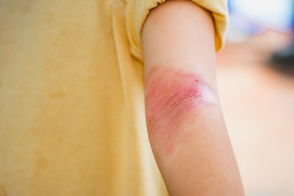atopic dermatitis treatments novomed clinic